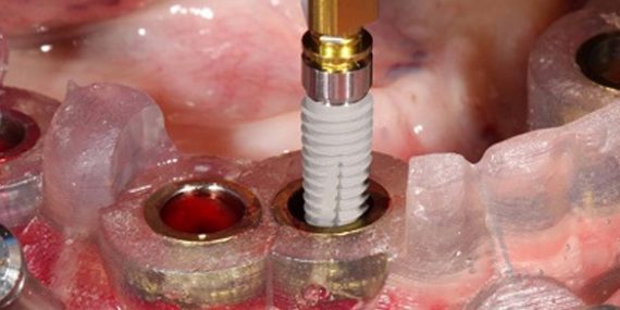 implante dental