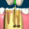 endodoncia y sus beneficios