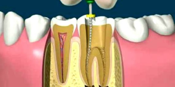 endodoncia y sus beneficios