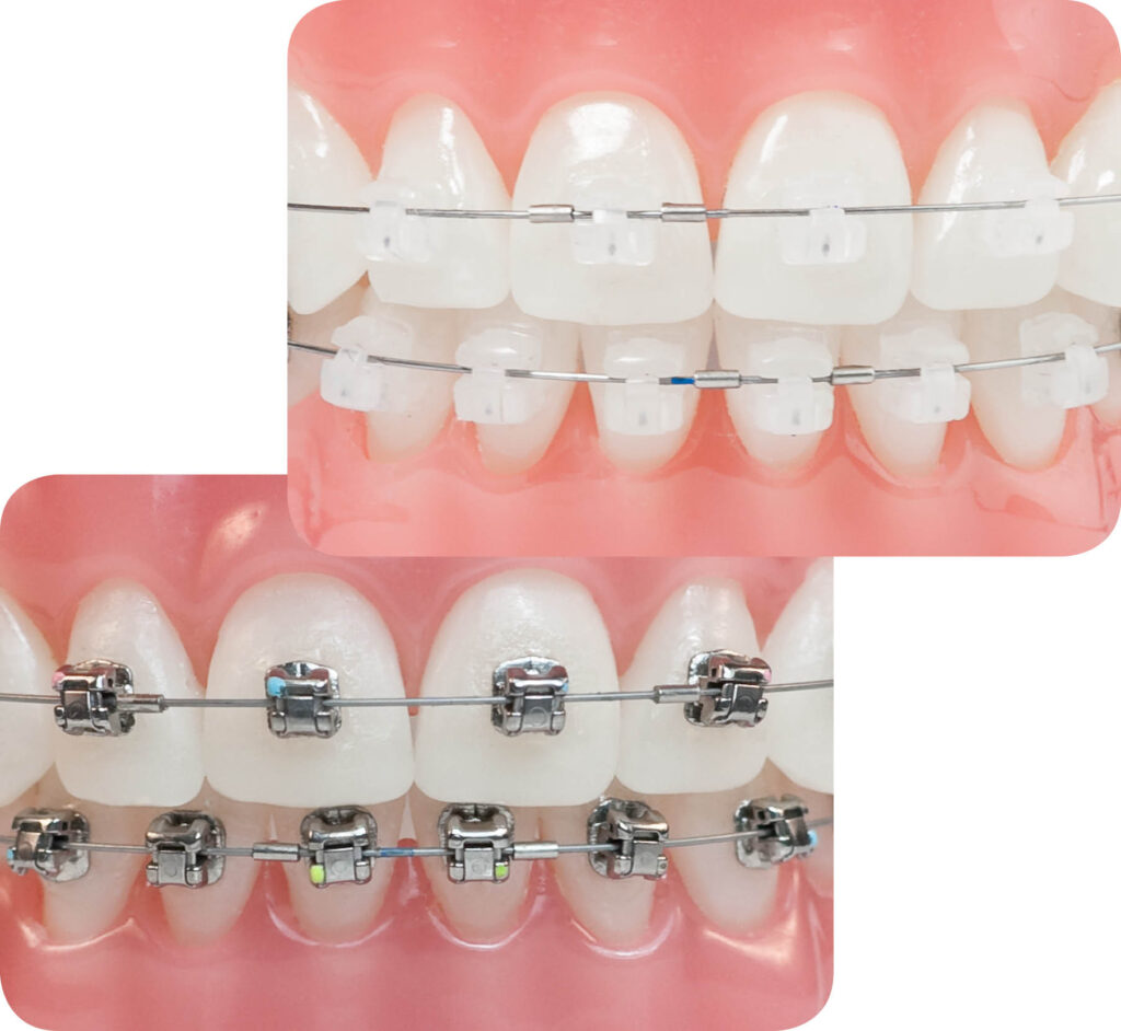 VENTAJAS DEL BRACKET AUTOLIGABLE Cl nica Dental Odontologists