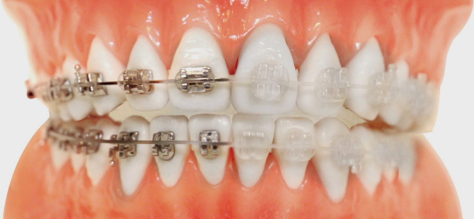 BRACKETS ZAFIRO Odontologists