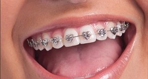 brackets