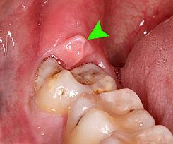 pericoronaritis