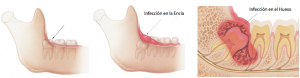 pericoronaritis