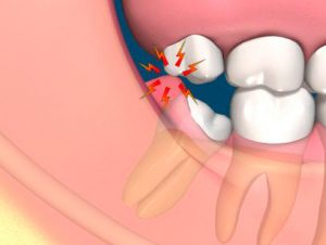 pericoronaritis