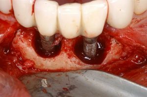 periimplantitis