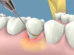 periodoncia